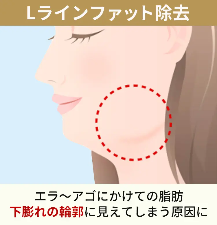 Lラインファットとは