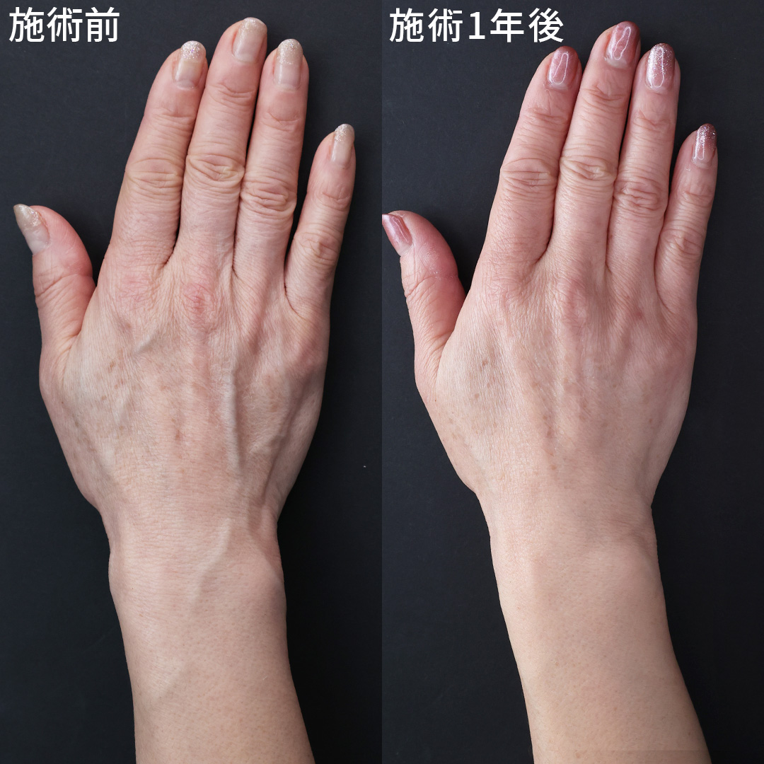 ハンドベイン（手のアンチエイジング・血管治療）の症例写真 施術前後 