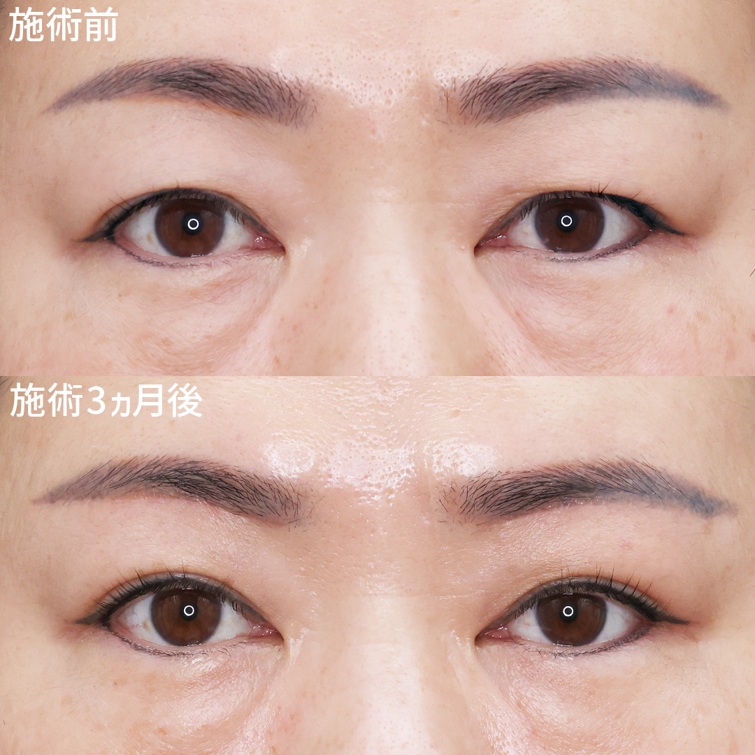 眉毛下切開術の症例写真 施術前後 