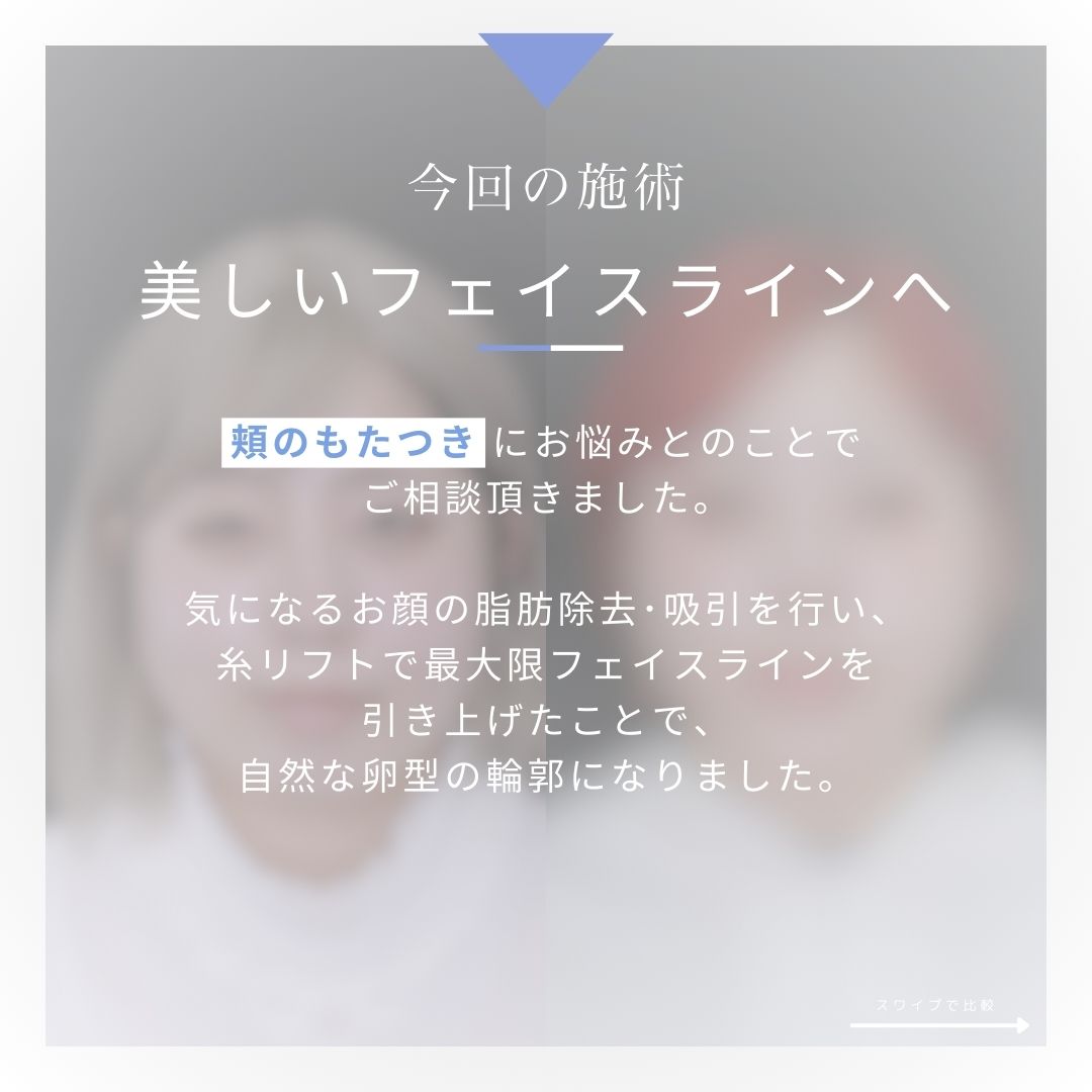 TAC式 ツヤ肌コラーゲンリフト®/ジョールファット除去/Lラインファット除去（エラ下脂肪除去）の症例写真 施術前後 