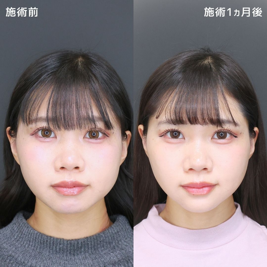 TAC式 ツヤ肌コラーゲンリフト®/顎のヒアルロン酸注射/エラボトックス注射の症例写真 施術前後 