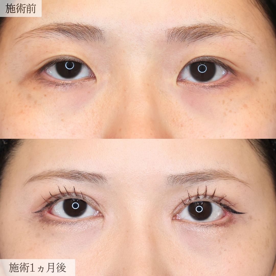 眼瞼下垂（目つき矯正）/二重切開（全切開法）/上眼瞼切開術の症例写真 施術前後 