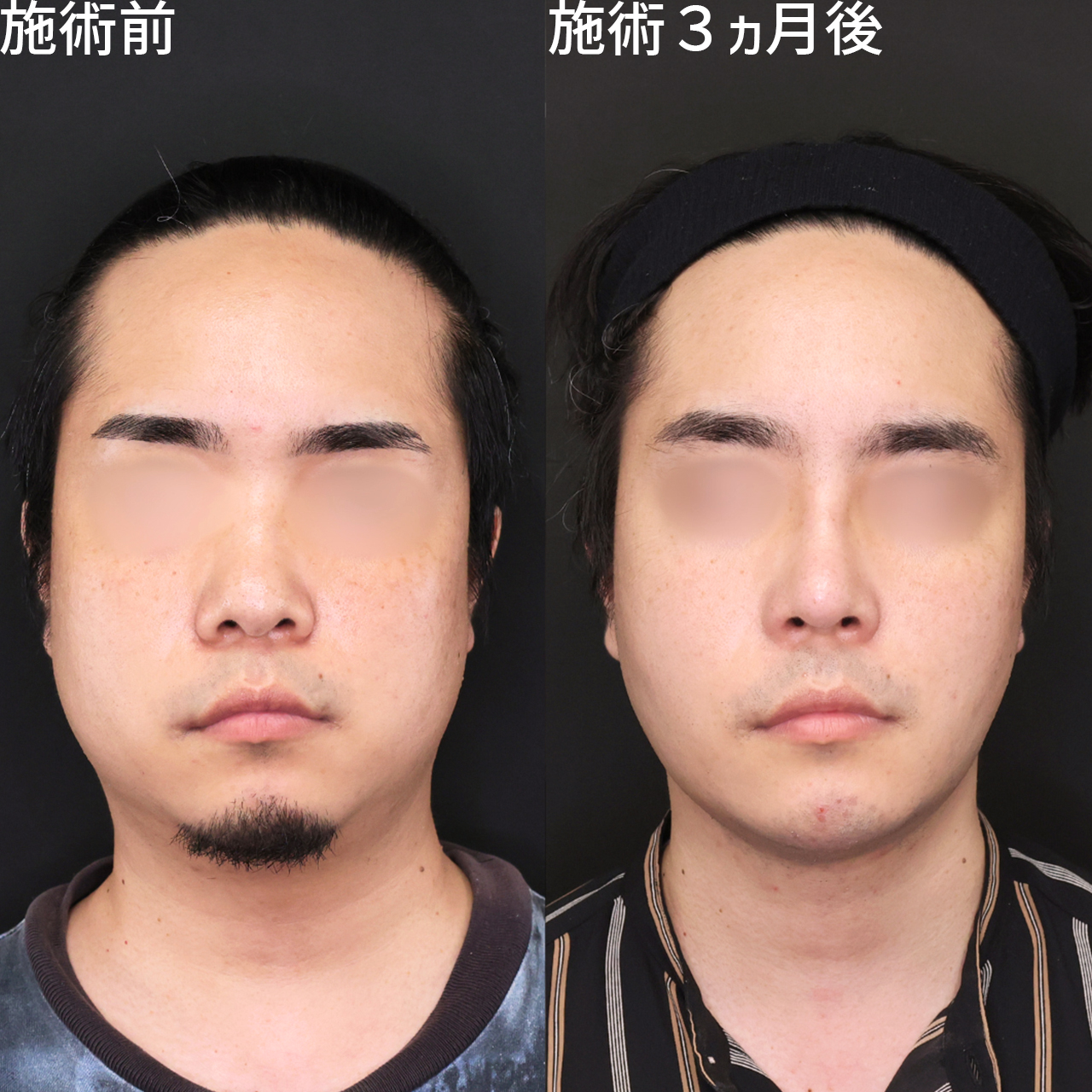 TAC式 ツヤ肌コラーゲンリフト®/顎下の脂肪吸引/バッカルファット除去の症例写真 施術前後 