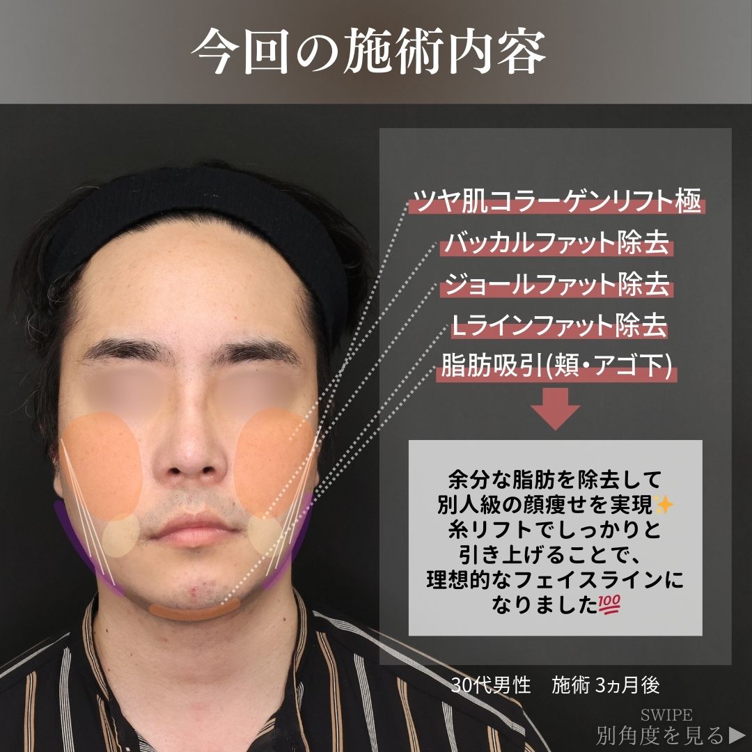 TAC式 ツヤ肌コラーゲンリフト®/顎下の脂肪吸引/バッカルファット除去の症例写真 施術前後 
