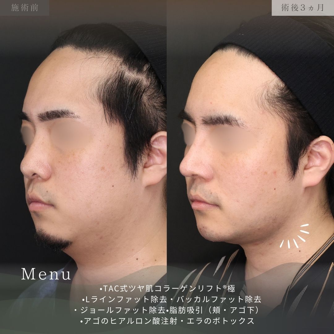 TAC式 ツヤ肌コラーゲンリフト®/顎下の脂肪吸引/バッカルファット除去の症例写真 施術前後 