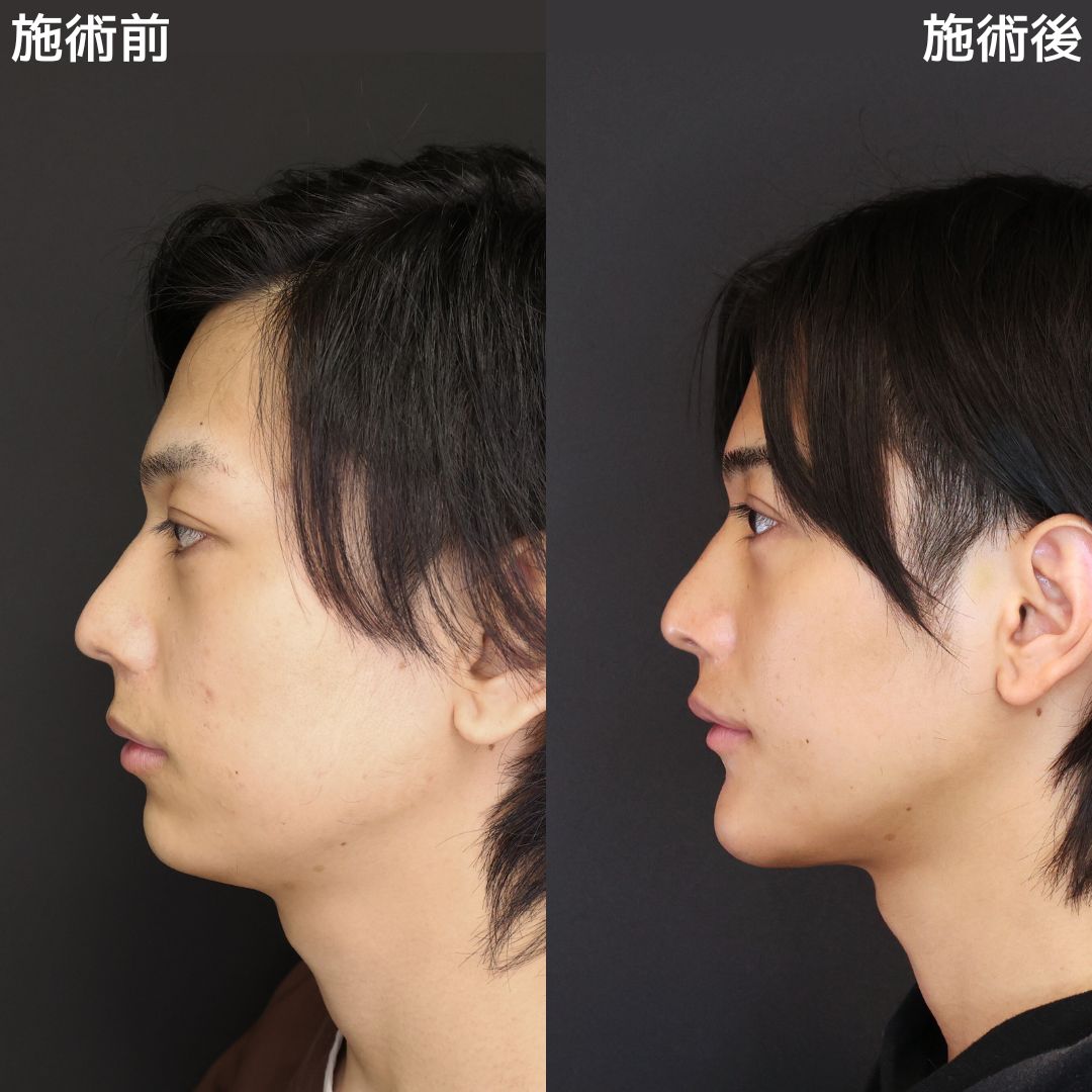 顎下の脂肪吸引/TAC式 ツヤ肌コラーゲンリフト®/人中短縮術(リップリフト)・外側人中短縮術の症例写真 施術前後 