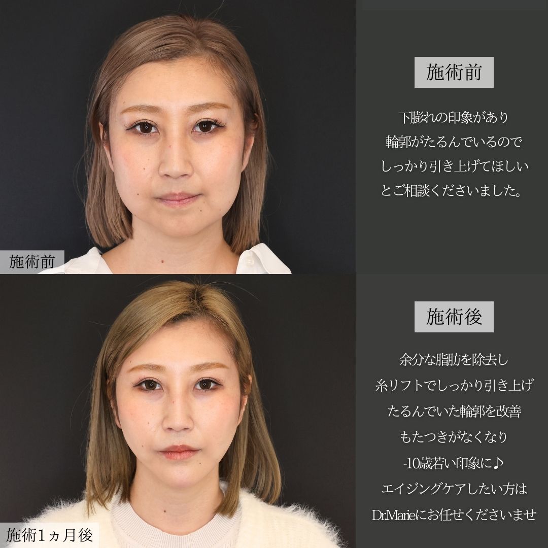 TAC式 ツヤ肌コラーゲンリフト®/ジョールファット除去/バッカルファット除去の症例写真 施術前後 