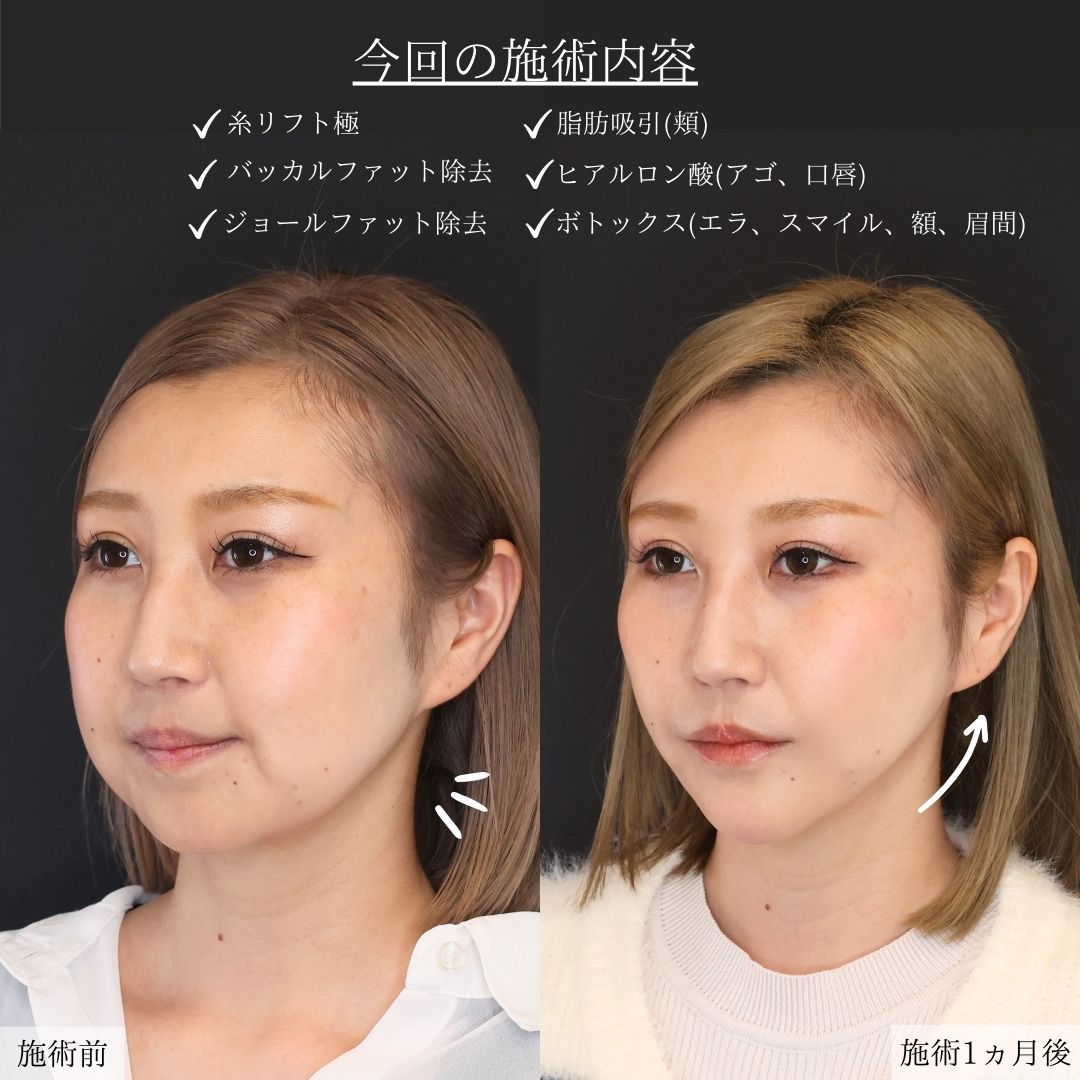 TAC式 ツヤ肌コラーゲンリフト®/ジョールファット除去/バッカルファット除去の症例写真 施術前後 