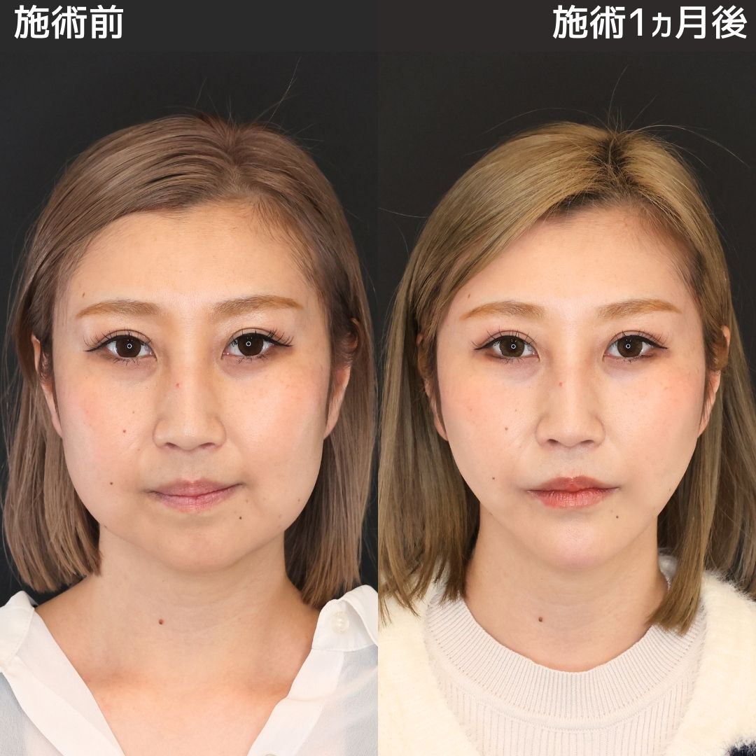 TAC式 ツヤ肌コラーゲンリフト®/ジョールファット除去/バッカルファット除去の症例写真 施術前後 
