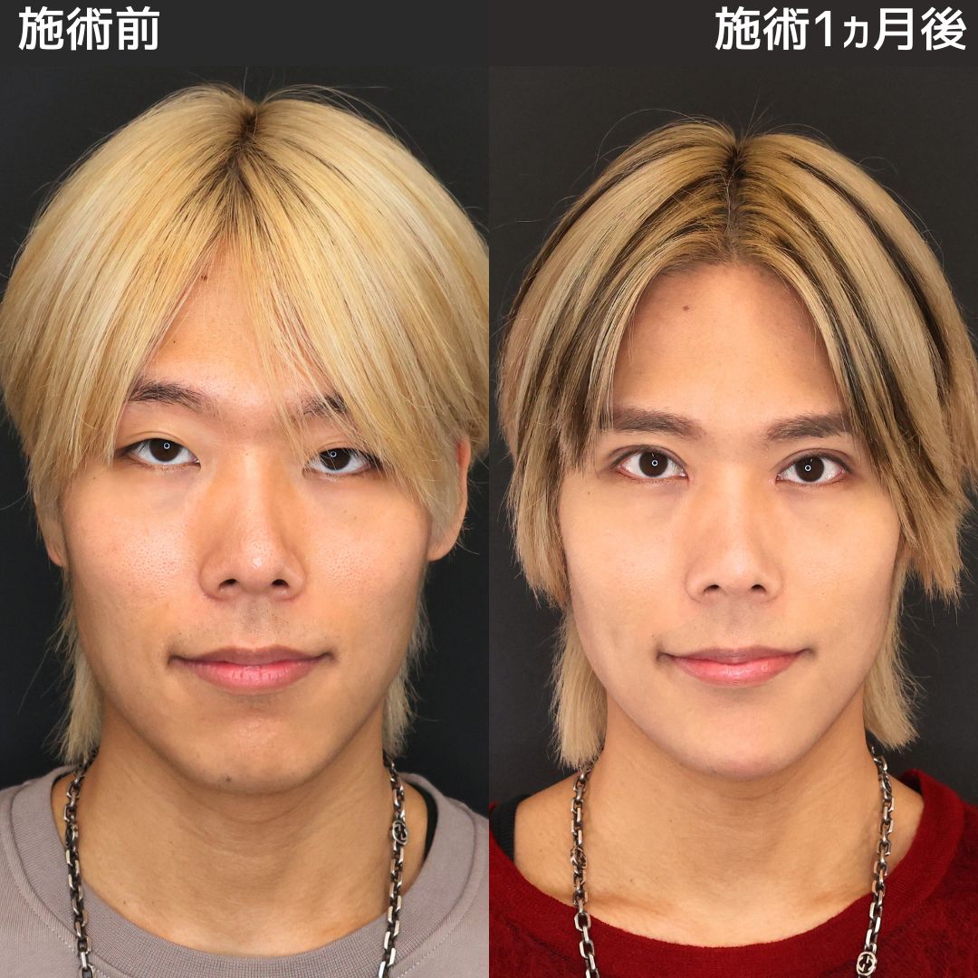 上眼瞼切開術/眼瞼下垂（目つき矯正）/目頭切開術の症例写真 施術前後 