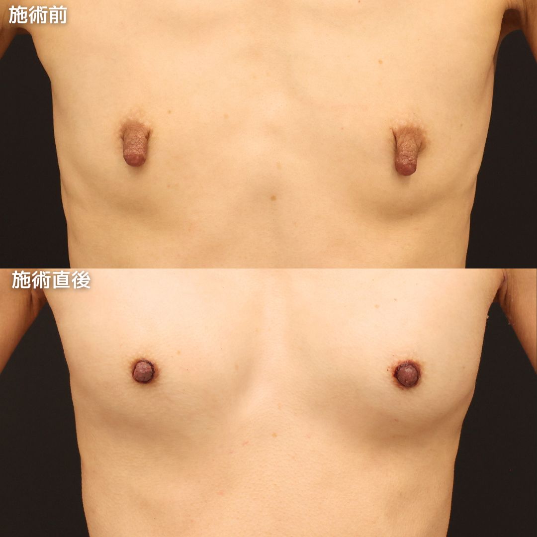 乳頭縮小術/ヒアルロン酸注入豊胸術（グラビアバスト）の症例写真 施術前後 