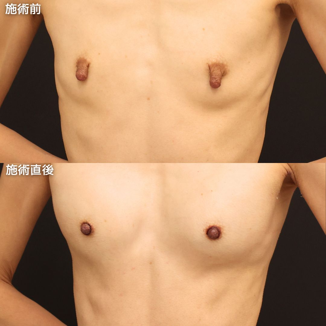 乳頭縮小術/ヒアルロン酸注入豊胸術（グラビアバスト）の症例写真 施術前後 
