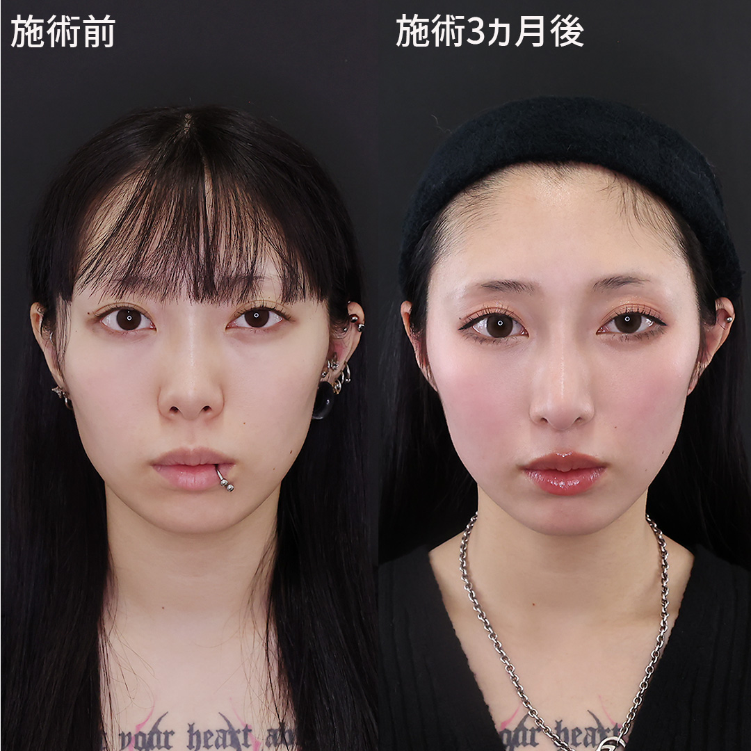 鼻中隔延長術/鼻尖形成・鼻尖縮小/隆鼻術（プロテーゼ・自家組織）の症例写真 施術前後 