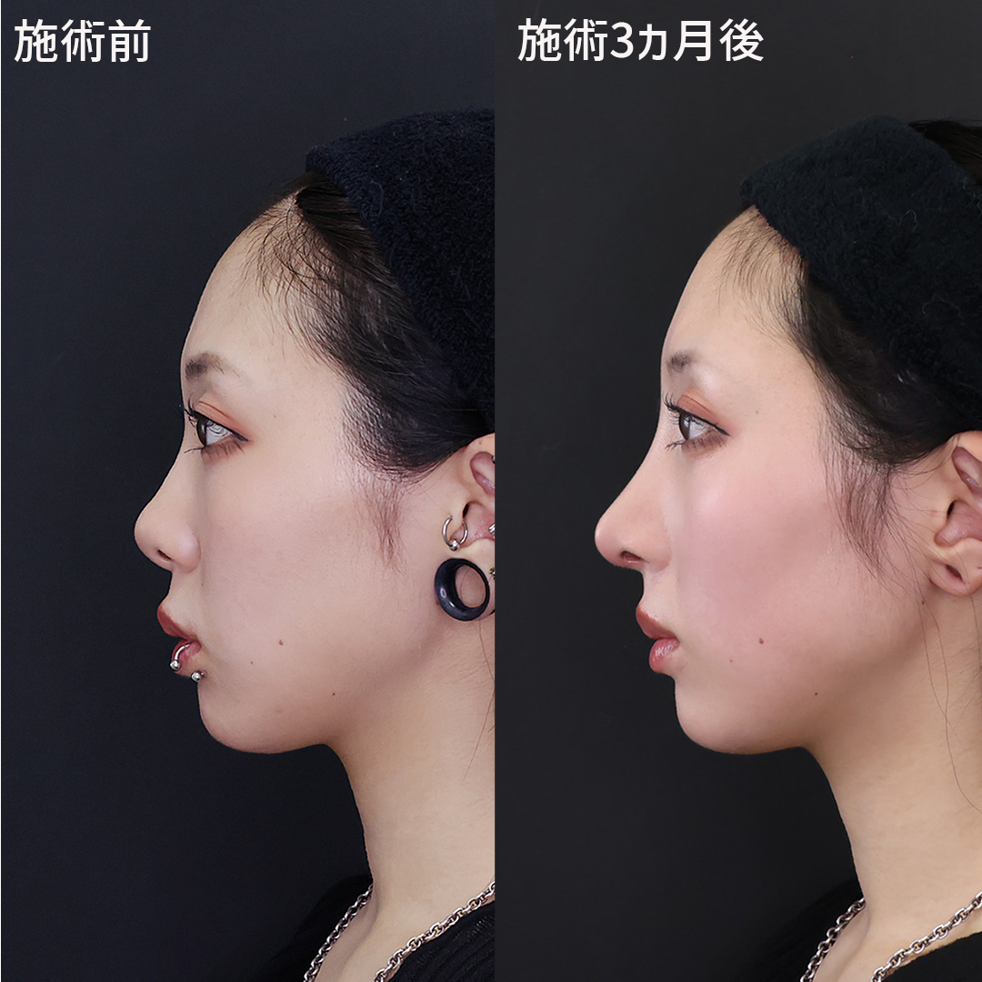鼻中隔延長術/鼻尖形成・鼻尖縮小/隆鼻術（プロテーゼ・自家組織）の症例写真 施術前後 