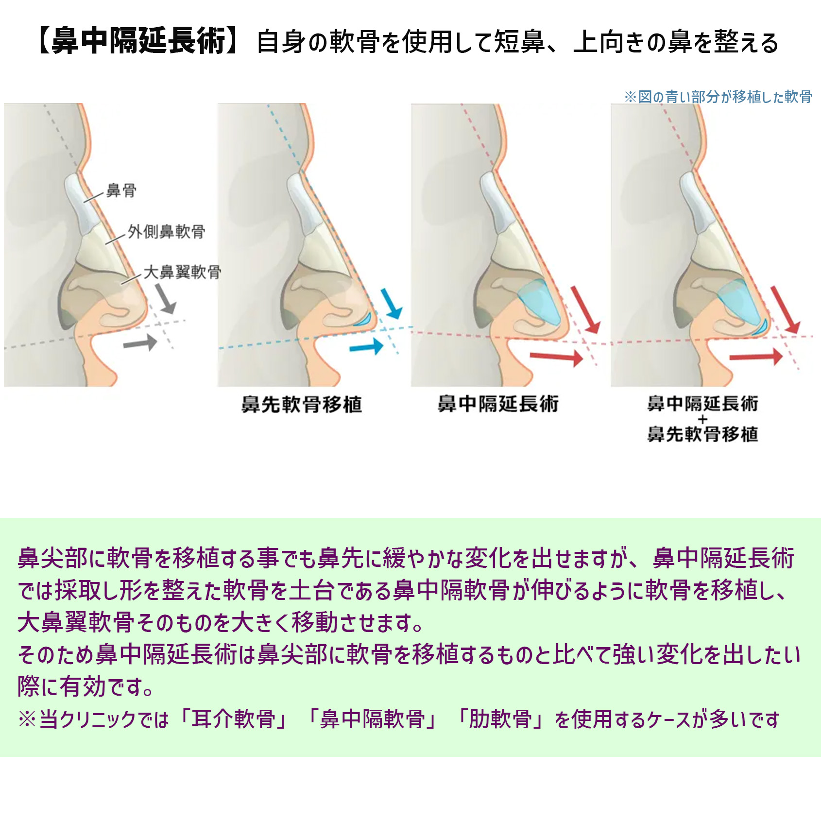 鼻中隔延長術/鼻尖形成・鼻尖縮小/隆鼻術（プロテーゼ・自家組織）の症例写真 施術前後 