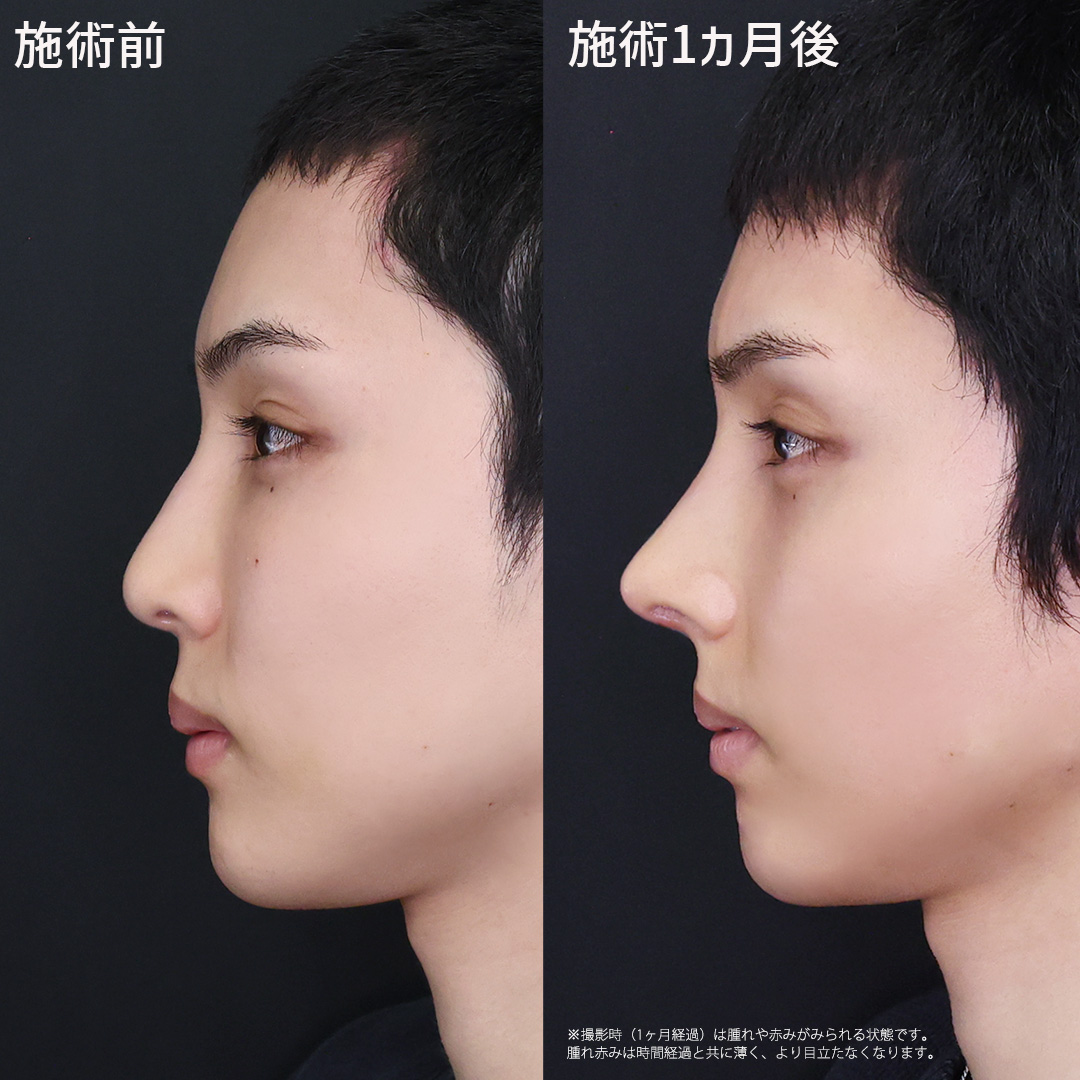 鼻中隔延長術/鼻先軟骨移植/鼻尖形成・鼻尖縮小の症例写真 施術前後 