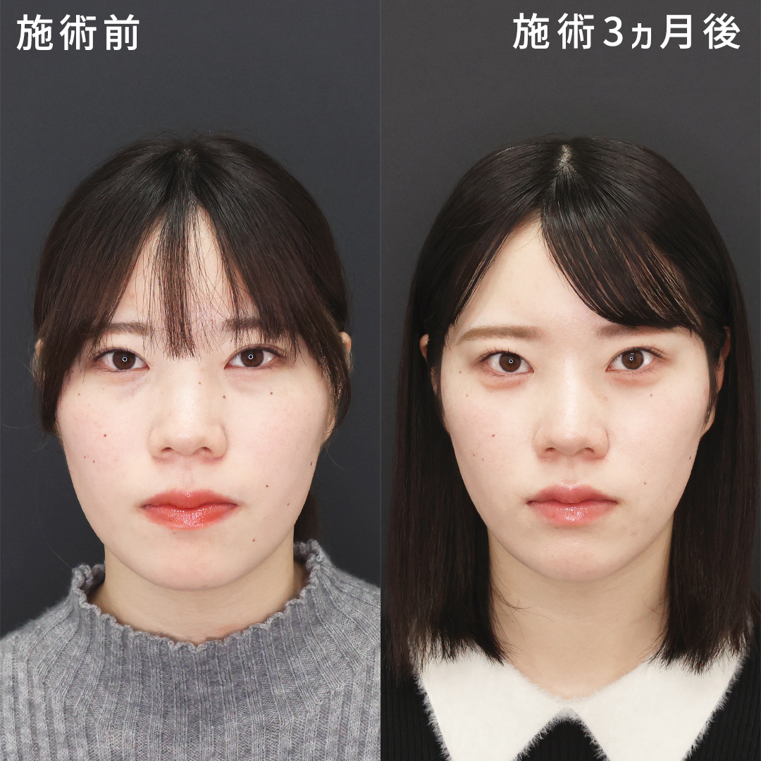 下眼瞼脱脂術（目の下のたるみ取り・目の下の脂肪ふくらみ取り）/顎下の脂肪吸引/Lラインファット除去（エラ下脂肪除去）の症例写真 施術前後 