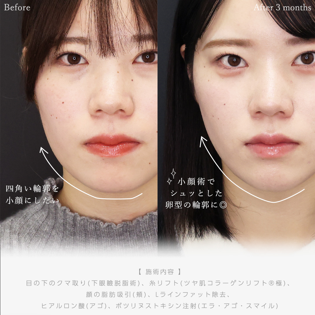 下眼瞼脱脂術（目の下のたるみ取り・目の下の脂肪ふくらみ取り）/顎下の脂肪吸引/Lラインファット除去（エラ下脂肪除去）の症例写真 施術前後 