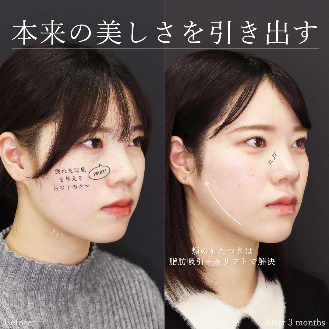 下眼瞼脱脂術（目の下のたるみ取り・目の下の脂肪ふくらみ取り）/顎下の脂肪吸引/Lラインファット除去（エラ下脂肪除去）の症例写真 施術前後 