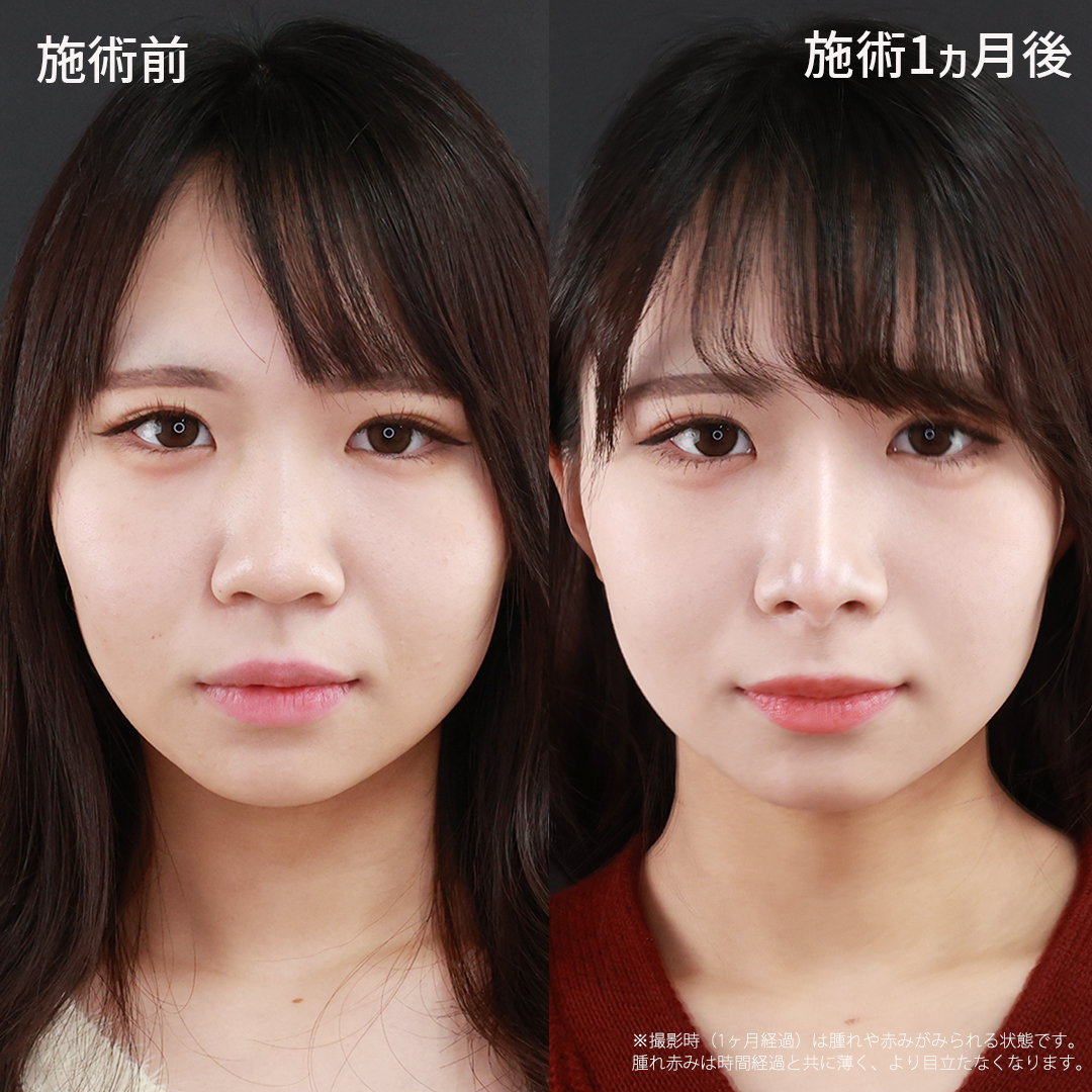 鼻中隔延長術/鼻先軟骨移植/鼻尖形成・鼻尖縮小の症例写真 施術前後 