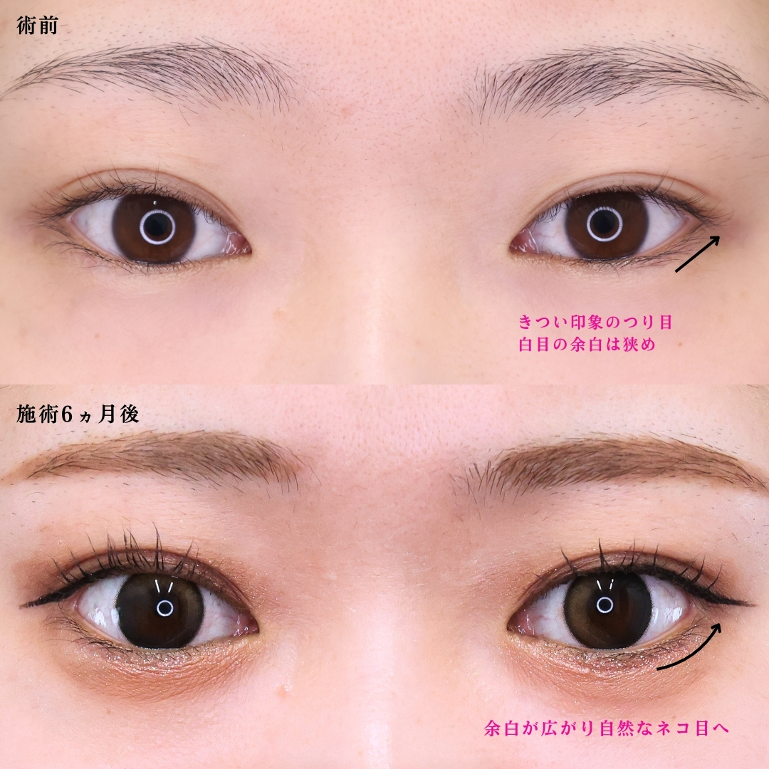 グラマラスライン（タレ目形成）/目尻切開術の症例写真 施術前後 