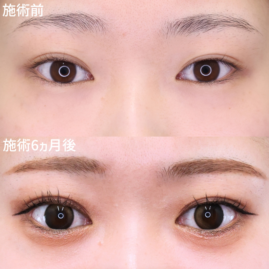 グラマラスライン（タレ目形成）/目尻切開術の症例写真 施術前後 