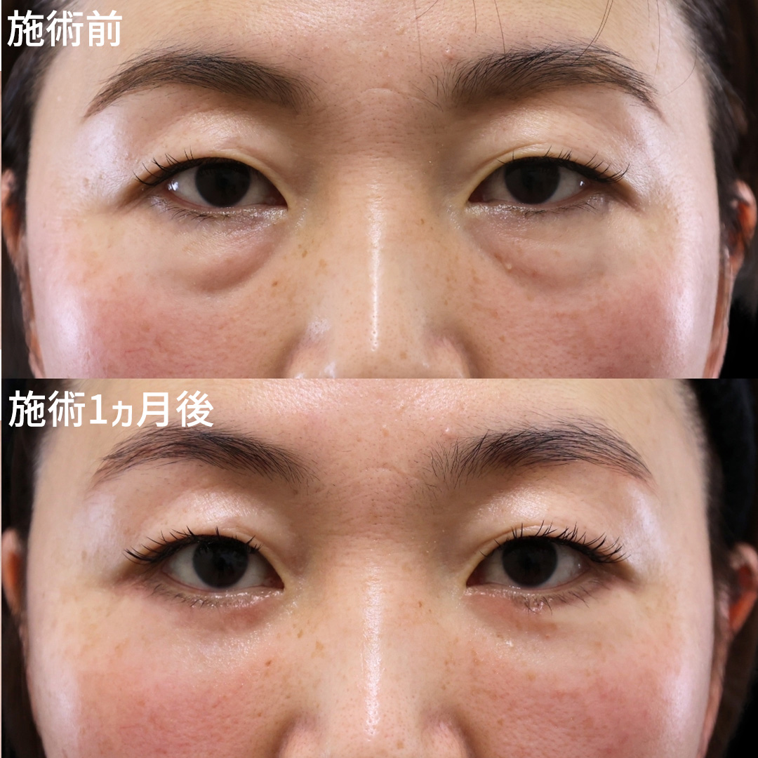 下眼瞼切開術（クマ・たるみとり）の症例写真 施術前後 