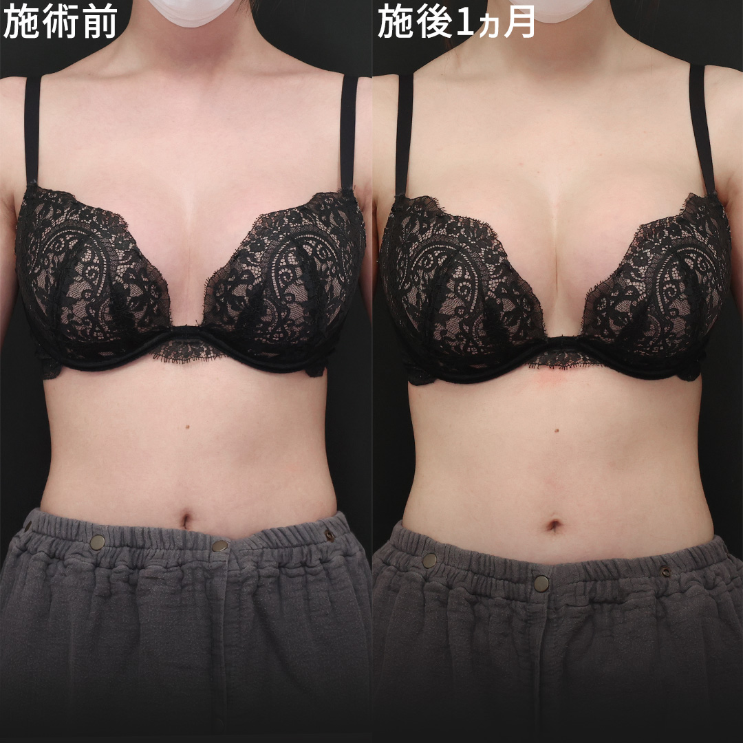 豊胸・バスト：その他/シリコンバッグ豊胸（人工乳腺バッグ）の症例写真 施術前後 