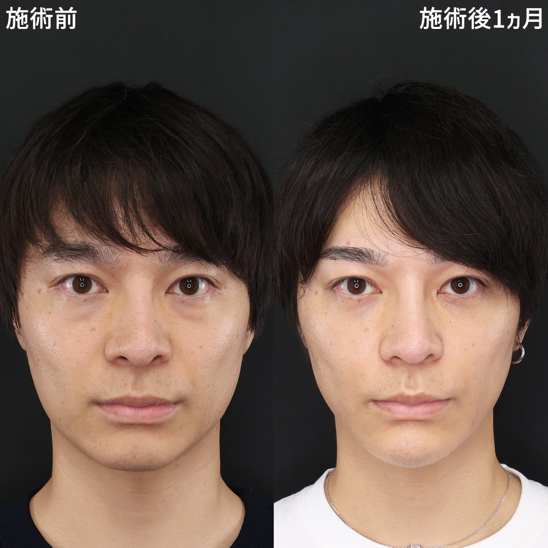 TAC式 ツヤ肌コラーゲンリフト®/TAC式 ショッピングリフト/ほうれい線のヒアルロン酸注射の症例写真 施術前後 