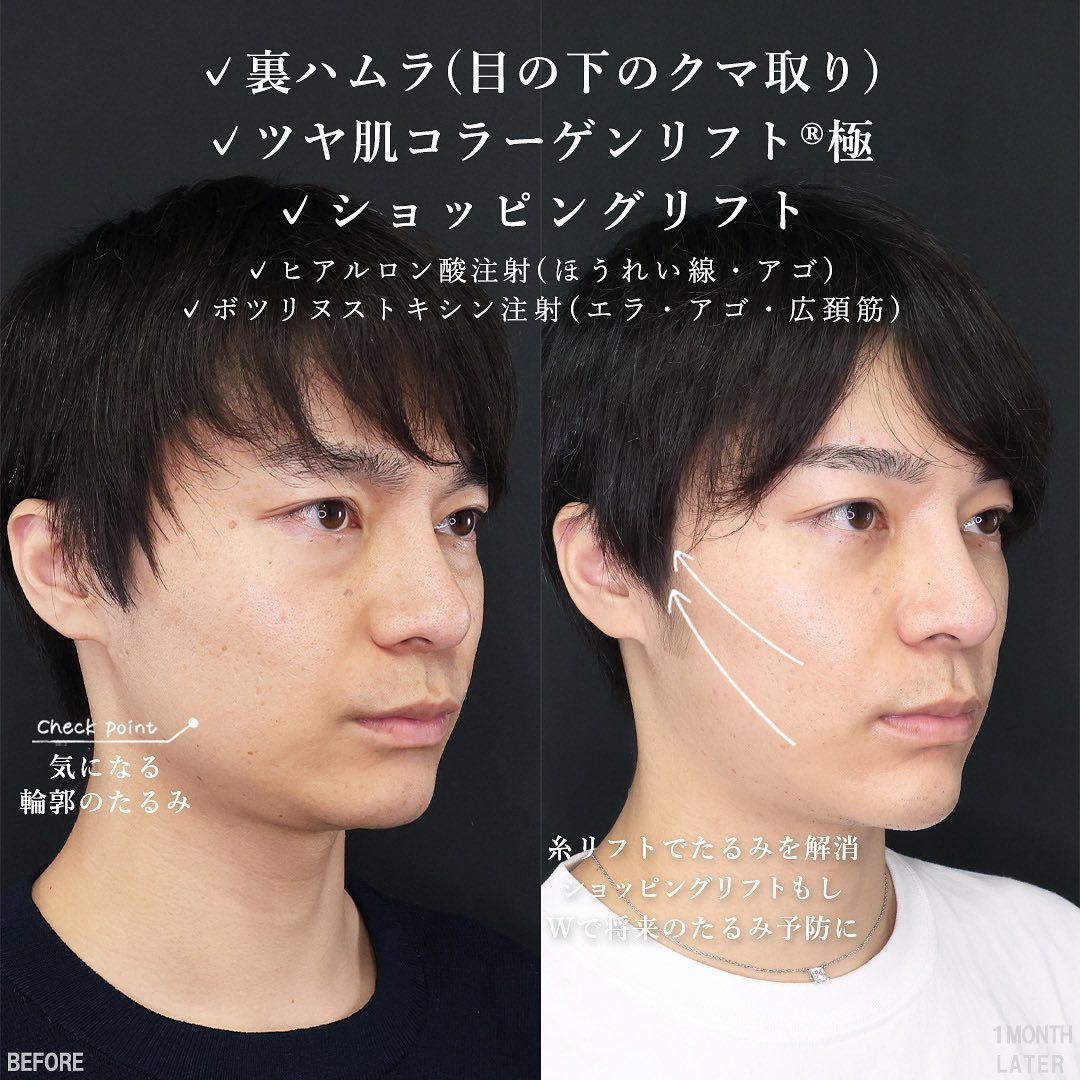 TAC式 ツヤ肌コラーゲンリフト®/TAC式 ショッピングリフト/ほうれい線のヒアルロン酸注射の症例写真 施術前後 