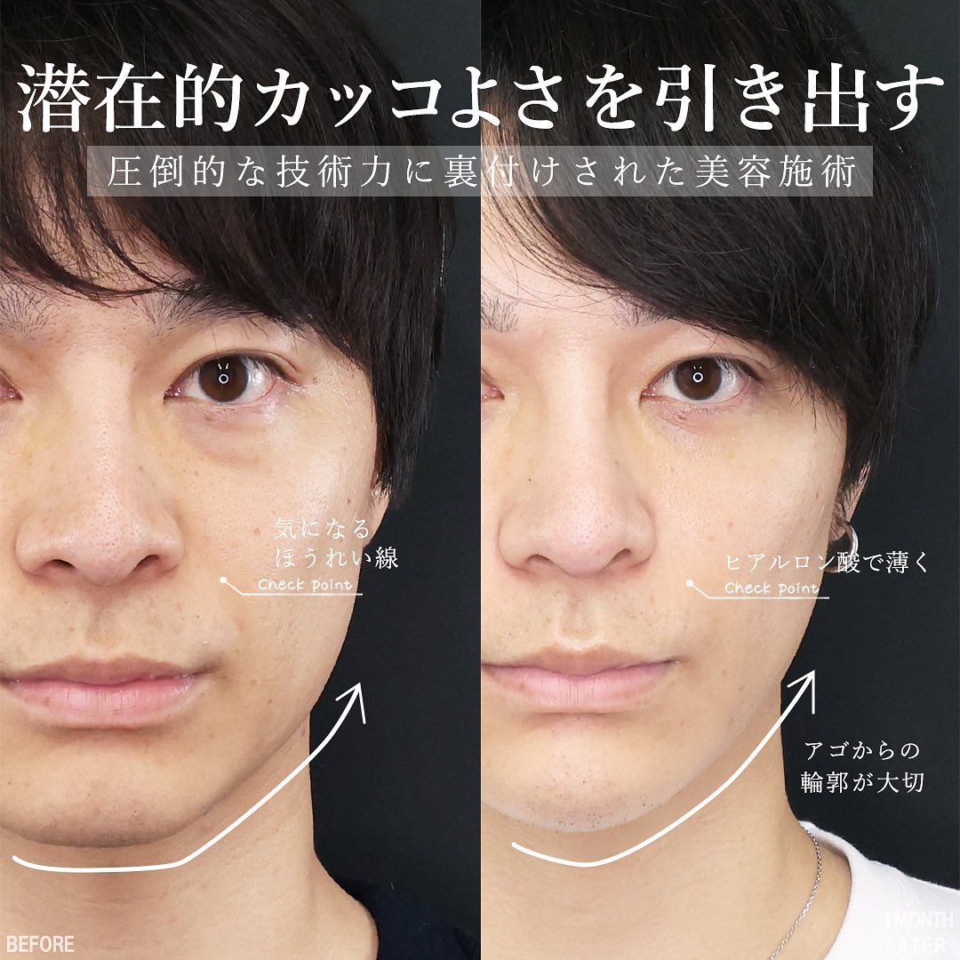 TAC式 ツヤ肌コラーゲンリフト®/TAC式 ショッピングリフト/ほうれい線のヒアルロン酸注射の症例写真 施術前後 