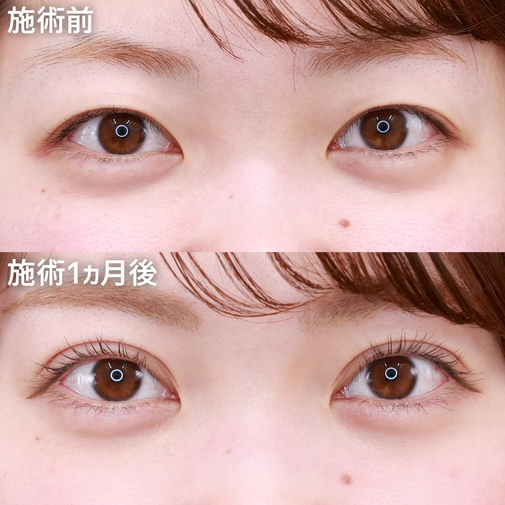 クイックコスメリングの症例写真 施術前後 