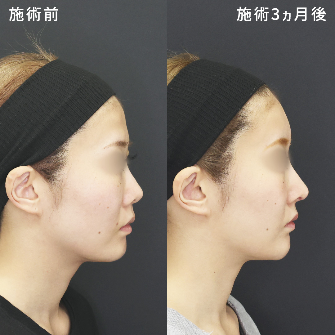 鼻中隔延長術/鼻尖形成・鼻尖縮小/鼻先軟骨移植の症例写真 施術前後 