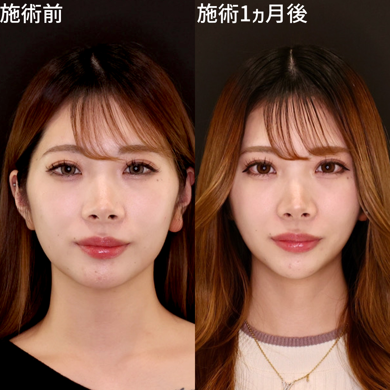 ジョールファット除去/顎下の脂肪吸引/TAC式 ツヤ肌コラーゲンリフト®の症例写真 施術前後 