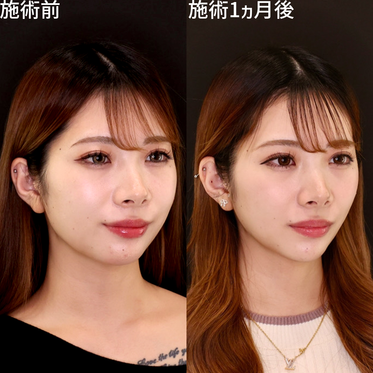 ジョールファット除去/顎下の脂肪吸引/TAC式 ツヤ肌コラーゲンリフト®の症例写真 施術前後 
