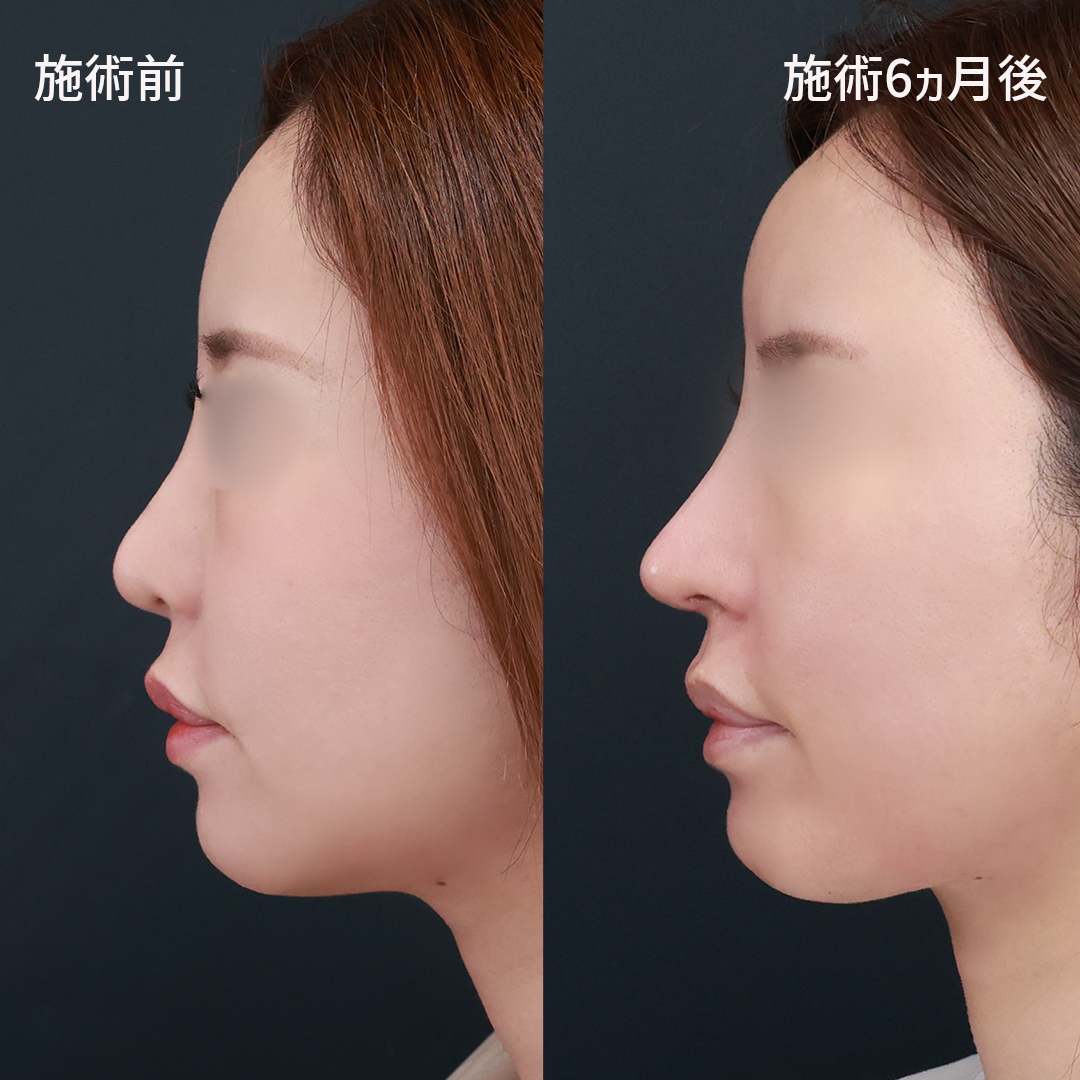 鼻中隔延長術/鼻先軟骨移植/鼻孔縁挙上術の症例写真 施術前後 