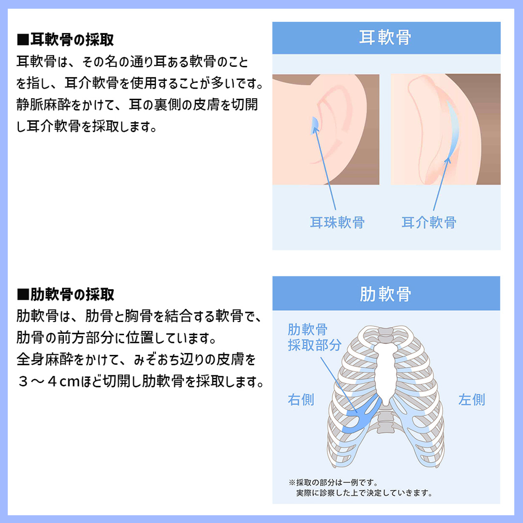 鼻中隔延長術/鼻先軟骨移植/鼻孔縁挙上術の症例写真 施術前後 
