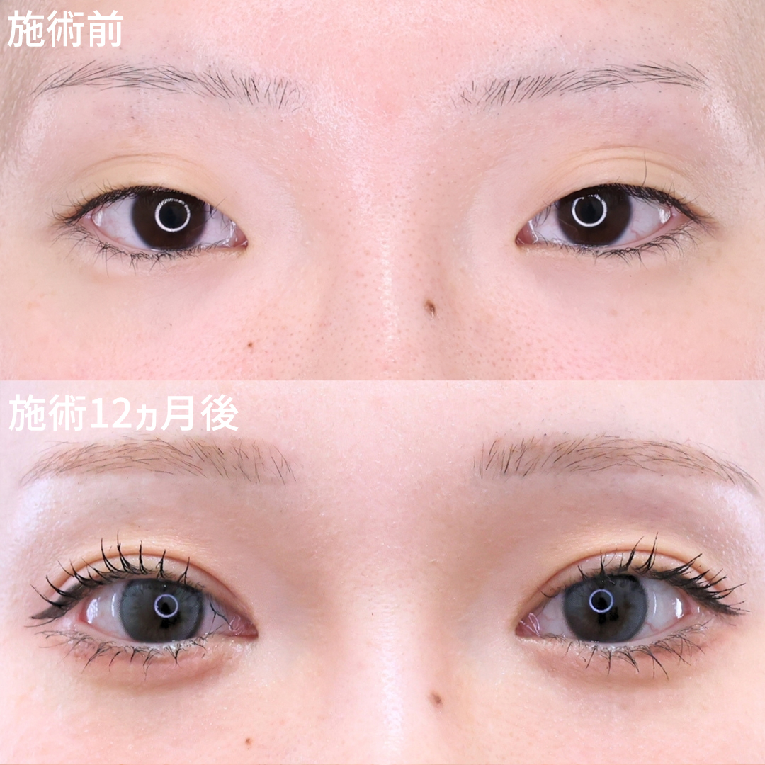二重埋没法/目頭切開術/目尻切開術の症例写真 施術前後 