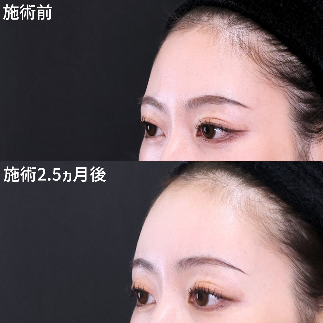 おでこの脂肪注入（オルチャンデコ形成）の症例写真 施術前後 