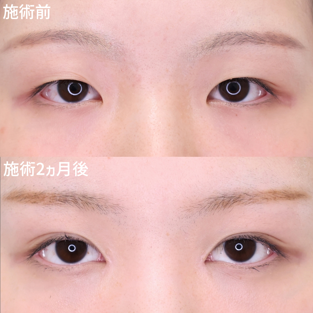 二重埋没法/目頭切開術の症例写真 施術前後 