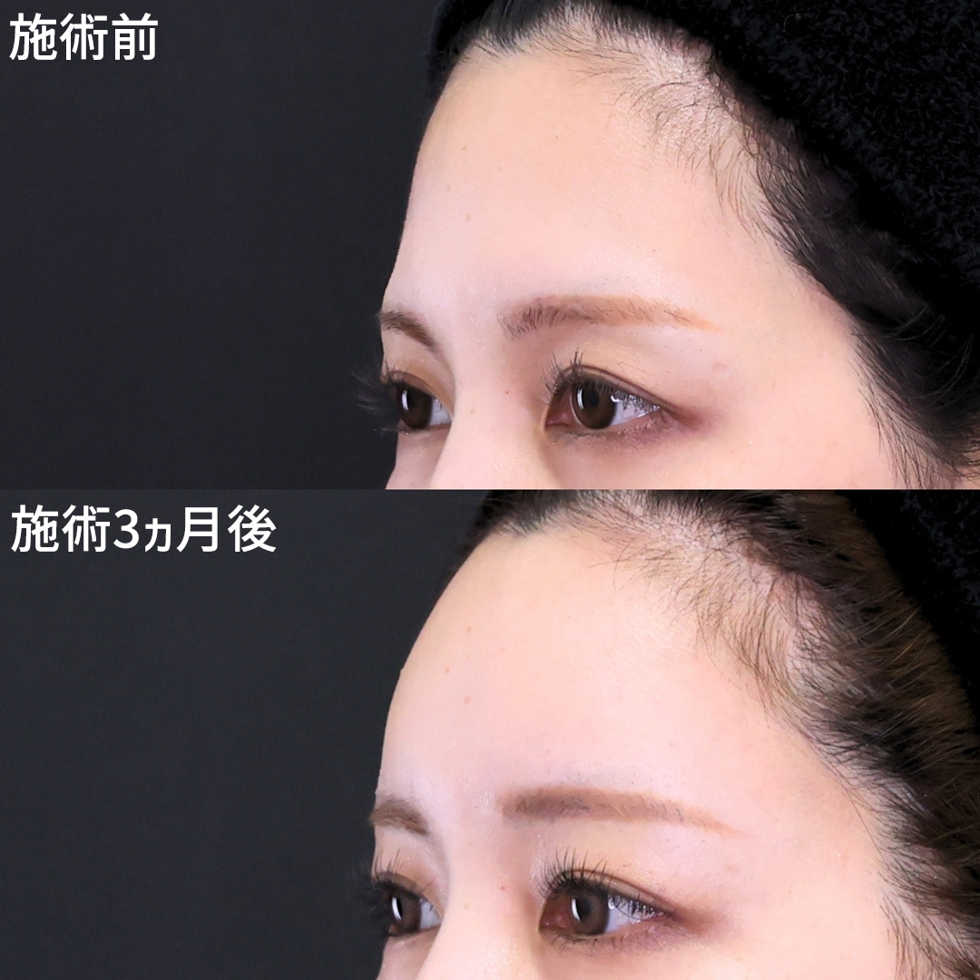おでこの脂肪注入（オルチャンデコ形成）の症例写真 施術前後 