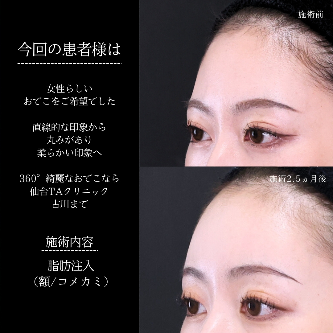 おでこの脂肪注入（オルチャンデコ形成）の症例写真 施術前後 