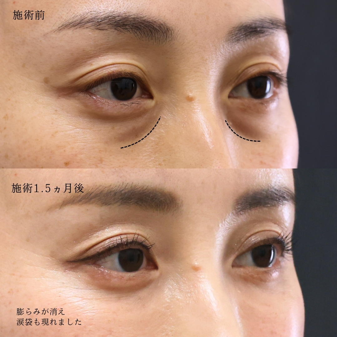 下眼瞼脱脂術（目の下のたるみ取り・目の下の脂肪ふくらみ取り）の症例写真 施術前後 