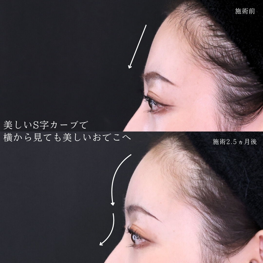おでこの脂肪注入（オルチャンデコ形成）の症例写真 施術前後 