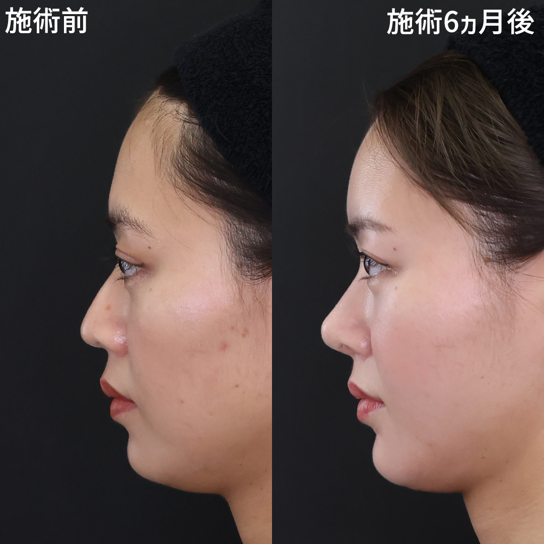 鼻尖形成・鼻尖縮小/鼻先軟骨移植/TAC式 鼻翼縮小術（小鼻縮小）の症例写真 施術前後 