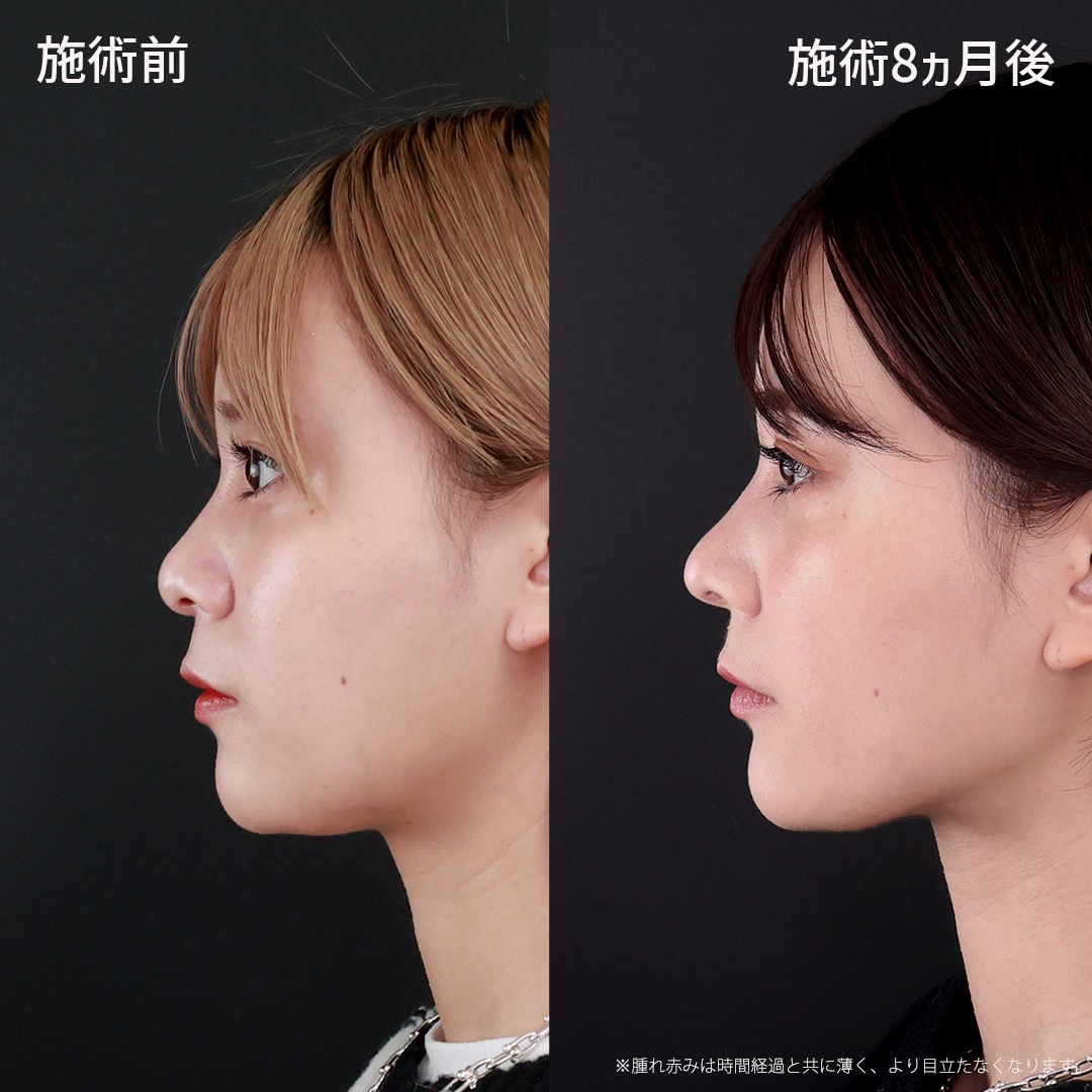 鼻中隔延長術/鼻先軟骨移植/鼻尖形成・鼻尖縮小の症例写真 施術前後 