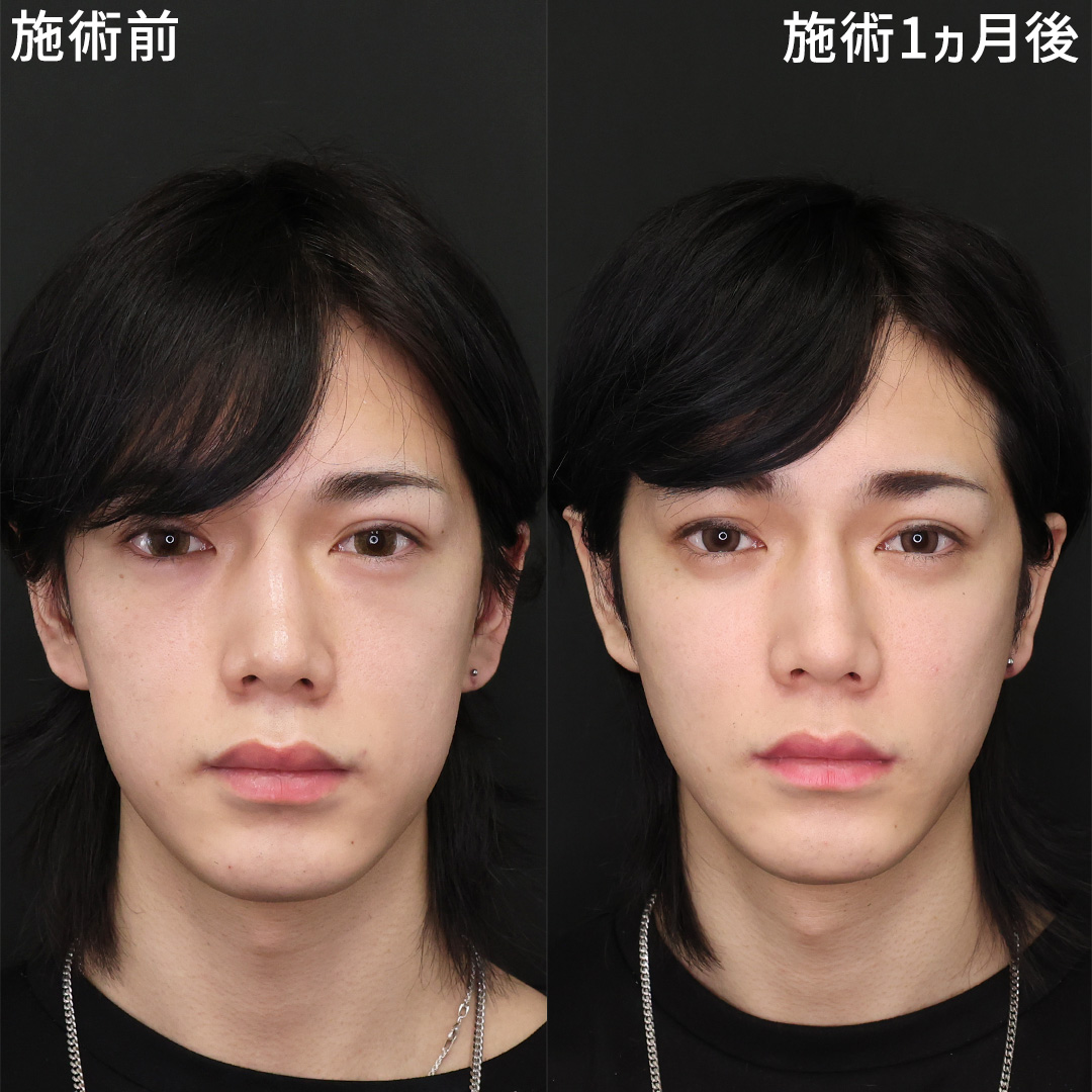 TAC式 ツヤ肌コラーゲンリフト®/下眼瞼脱脂術（目の下のたるみ取り・目の下の脂肪ふくらみ取り）/ゴルゴ線のヒアルロン酸注射の症例写真 施術前後 