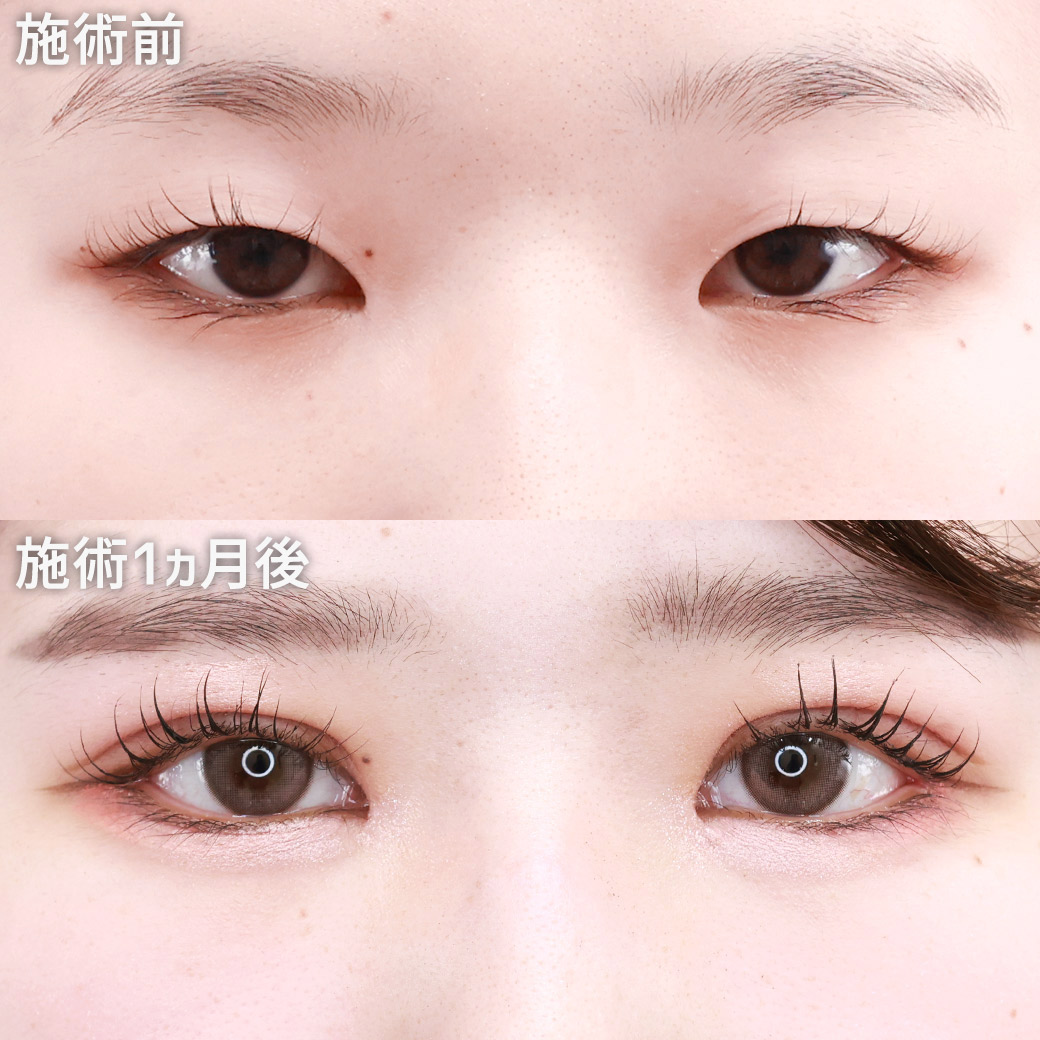 目頭切開術/目尻切開術/二重埋没法の症例写真 施術前後 