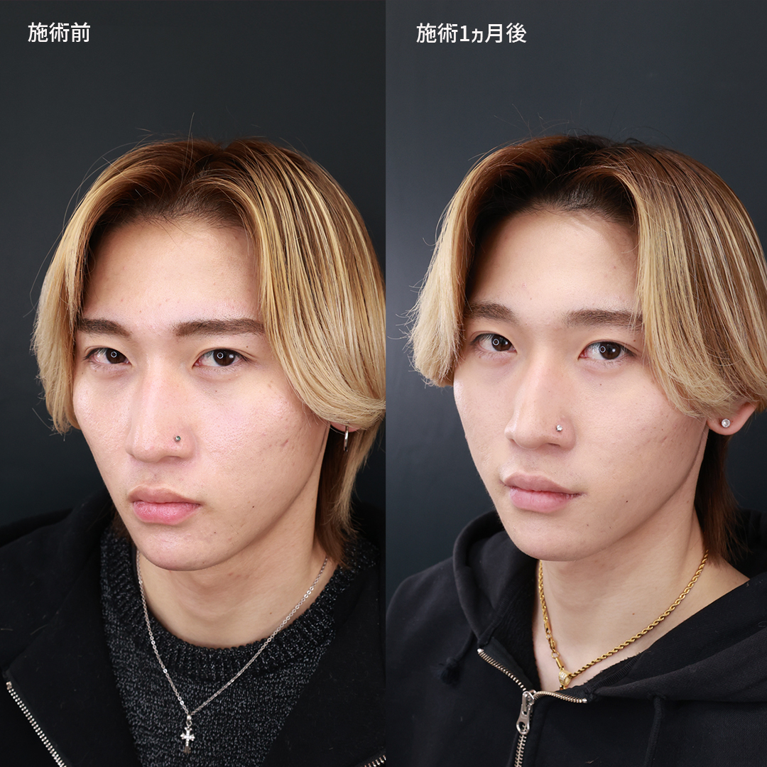 口角挙上・リフト（マイクロ切開法・内側法/口内法）の症例写真 施術前後 