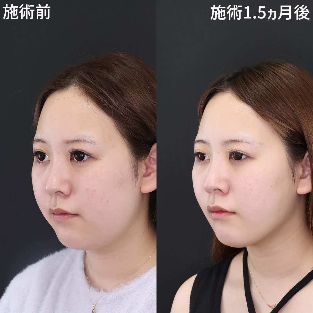 顎下の脂肪吸引/ジョールファット除去/TAC式 ツヤ肌コラーゲンリフト®の症例写真 施術前後 